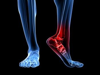 Stress on sale fracture heel
