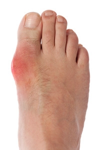Gout May Cause Severe Pain