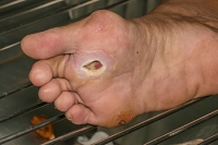 Diabetic Patients and Their Feet