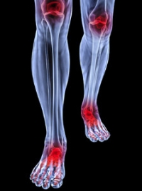 What to Expect When You Have Arthritic Feet