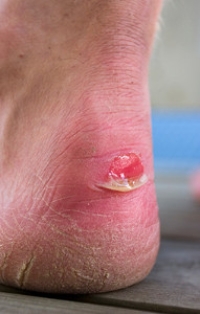 Home Remedies to Get Rid of Blisters