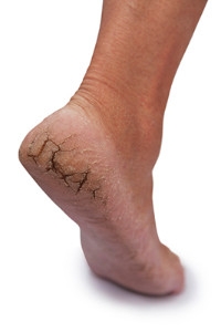 What Is The Most Common Cause Of Cracked Heels?