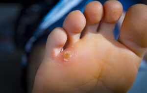 Treatments for Foot Corns