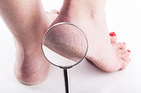 How Cracked Heels Develop and How to Treat Them