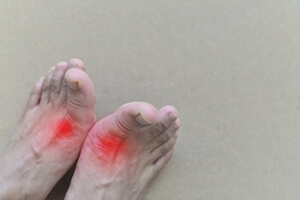 How Did I Develop Gout?