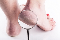 Treating and Preventing Cracked Heels