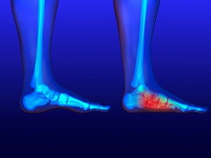 Understanding Flat Feet
