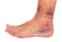 Strengthening the Ankle After a Sprain